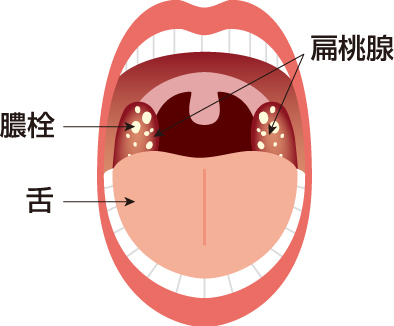 扁桃 腺 白い